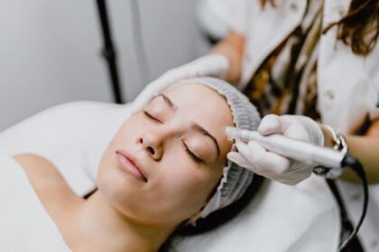 microneedling